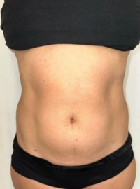 Après — Abdomen